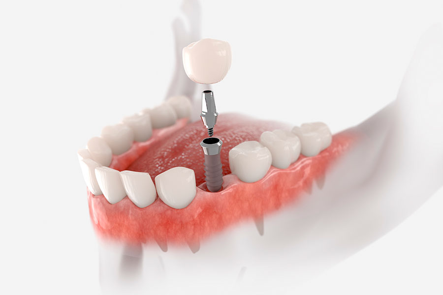 Implantes Carga Inmediata