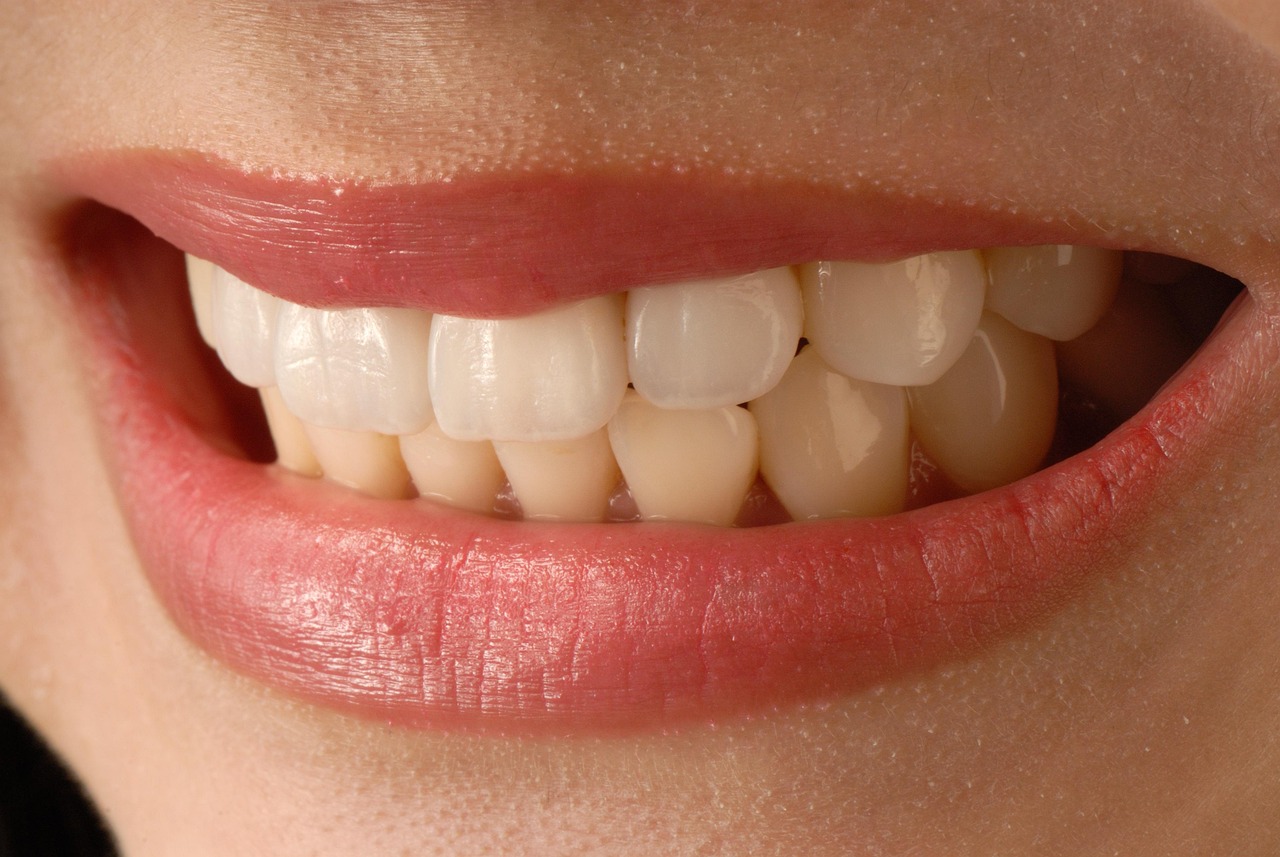 carillas dentales