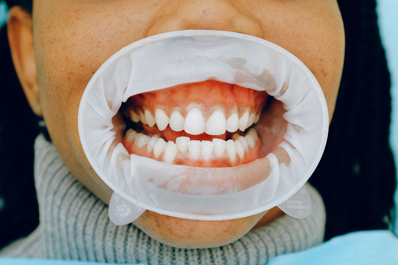 gingivitis