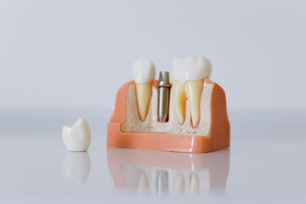Implantes Dentales en Lugo
