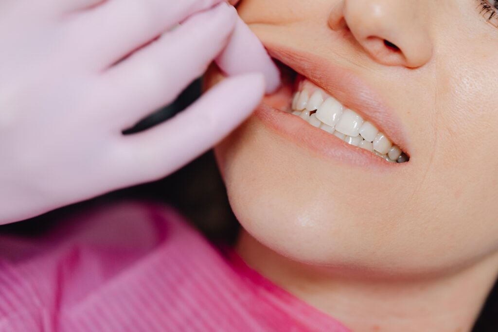recesion gingival